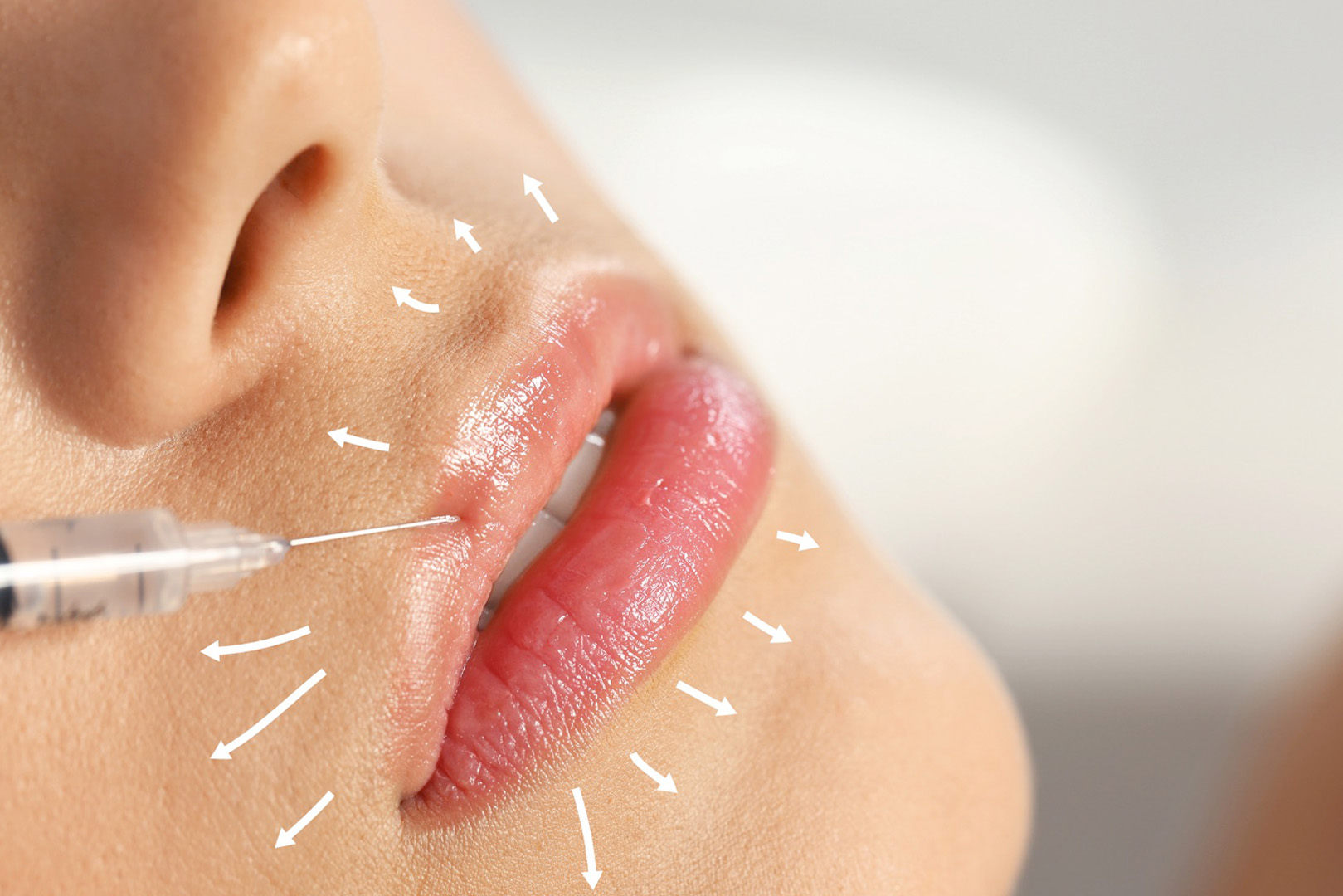 Ankara Dudak Dolgusu