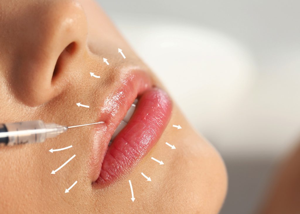 Ankara Dudak Dolgusu